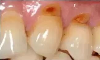 Tooth wedge shaped defect