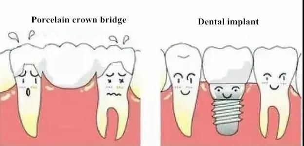 dental implant and porcelain teeth fix technology