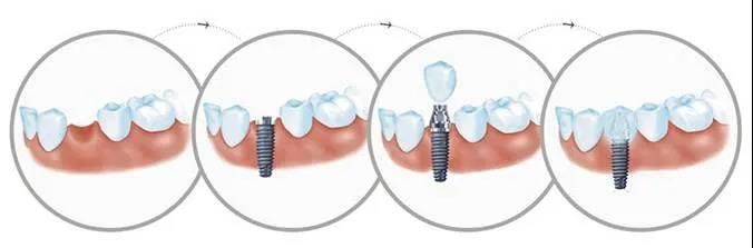 công nghệ cấy ghép nha khoa