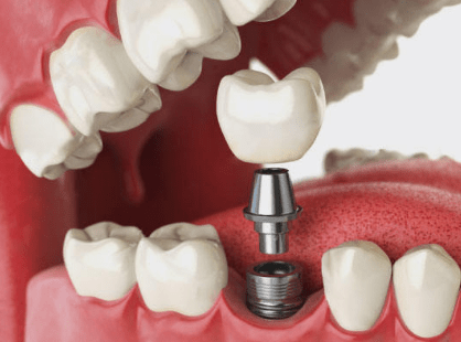 dental implant teeth