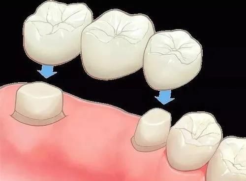 tecnología de puente dental de porcelana