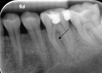 treatment of root canal in correct way