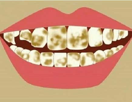 yellow and black teeth