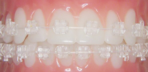 IS CERAMIC BRACES ARE THE RIGHT CHOICE FOR YOUR TEETH March 2024