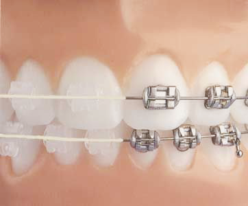 IS CERAMIC BRACES ARE THE RIGHT CHOICE FOR YOUR TEETH March 2024