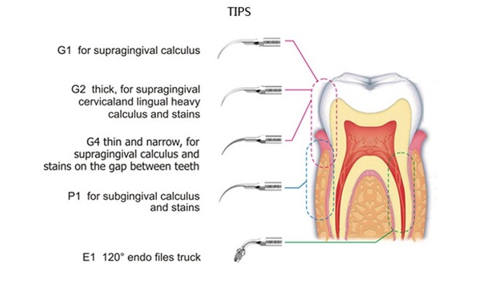 G1 G2 G4 P1 E1 tips comes to scaler dental machine