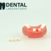 missing tooth implant training model