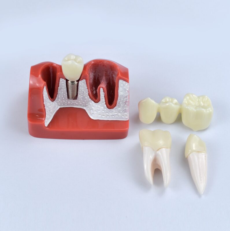 The Evolution Of Dental Implant Materials July 2024   Tooth Implant Model For Patient Communication And Education 796x800 